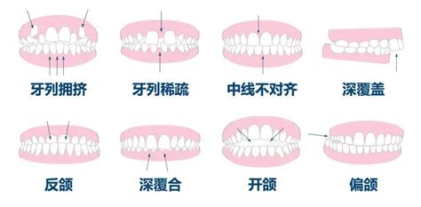 上排牙齒蓋住下排牙齒